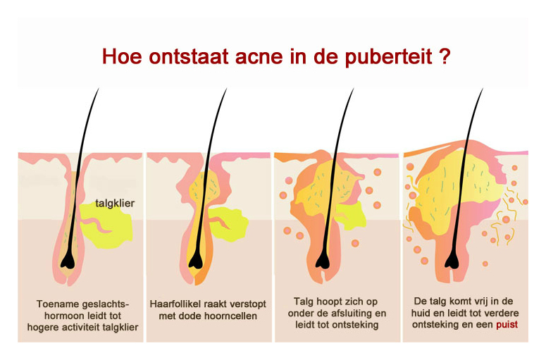 Charles Keasing Afname Beroep Acne - Schoonheidspraktijk Le Papillon